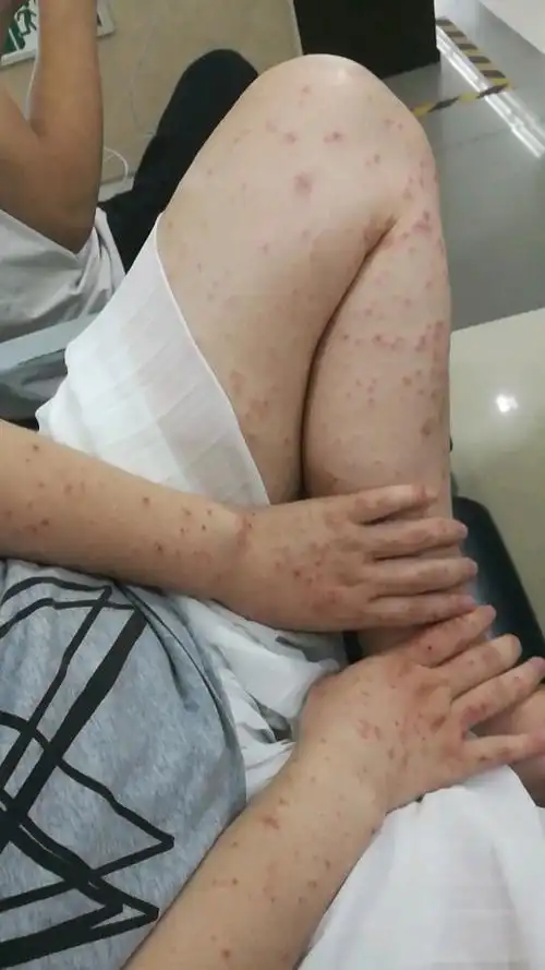 得了妊娠痒疹求止痒方法