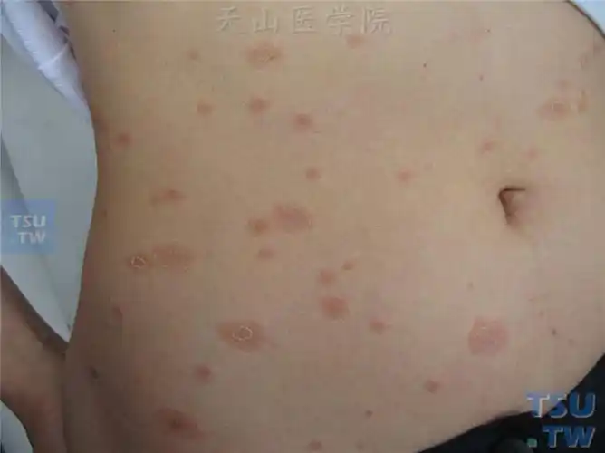 玫瑰糠疹(pityriasis rosea)的症状表现 - 皮肤病学 - 天山医学院