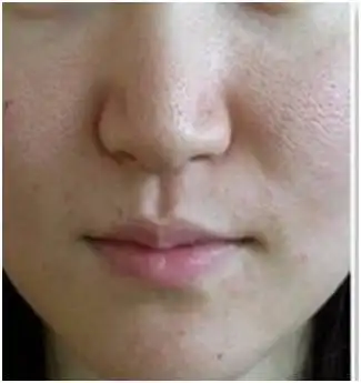 毛孔粗大怎么办?毛孔越来越大是什么原因?