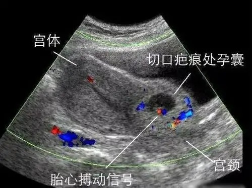 疤痕妊娠,顾名思义,就是着床在子宫疤痕处的孕囊,是一种特殊部位妊娠