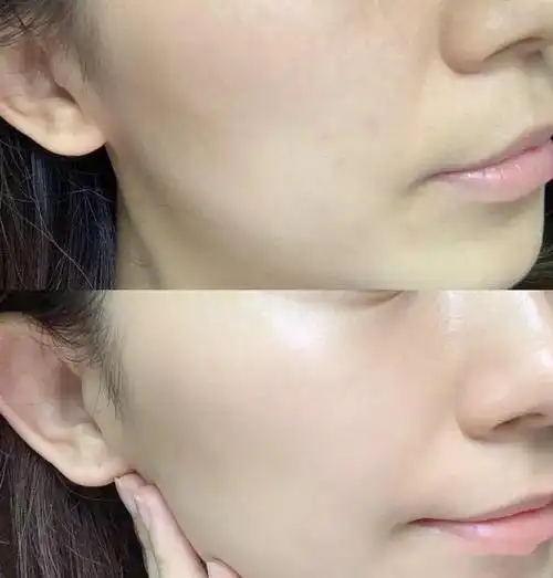 什么是脸部角质层修复脸部角质层的方法和技巧有哪些