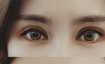 欧式平行双眼皮图片