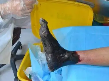 见患处皮肤全部变黑,肢端损害较重,脚部组织坏死,触之粗糙,干燥,此时