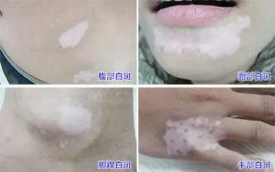 轻度白斑早期症状图片白斑图片真人照