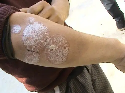 艾滋病皮肤症状图片,这些太明显了