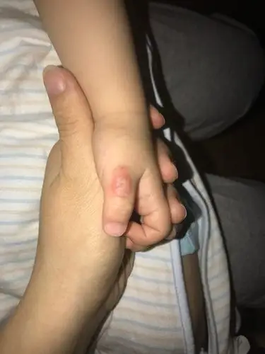 一岁宝宝吃手指上瘾,如何戒除,求帮助!