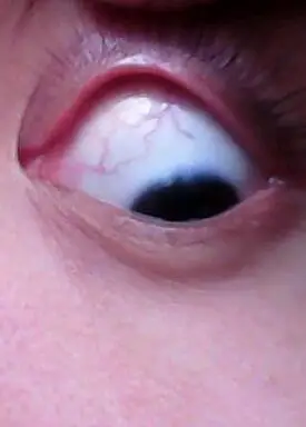 左眼上眼白,也就是翻开上眼皮的眼白一圈血丝,血丝是一个环状圈,没有