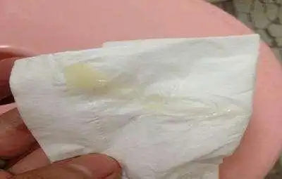 孕期白带异常警惕3大感染