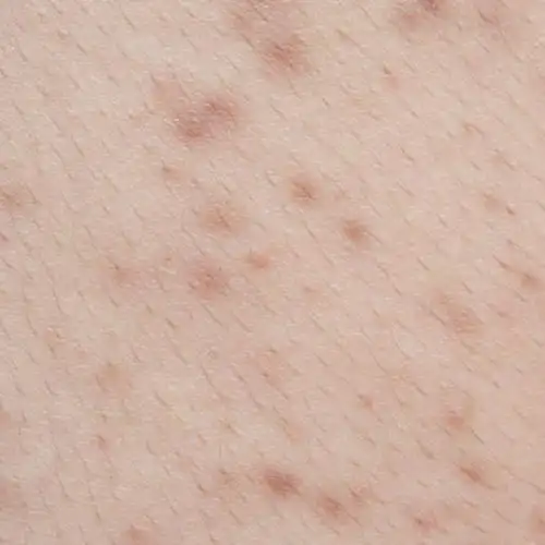 夏季这4种常见过敏性皮肤病你一定要了解