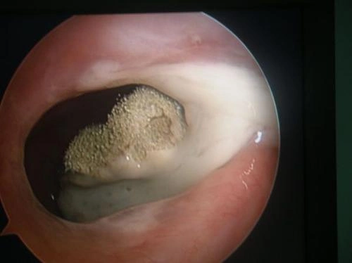 这是一种鼻腔鼻窦的特异性感染性疾病,叫"真菌性鼻窦炎"或者"霉菌性