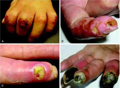 脸上皮肤坏死怎么办!