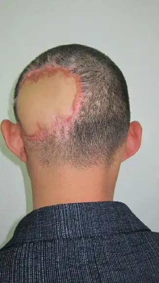 扩张器治疗疤痕性脱发