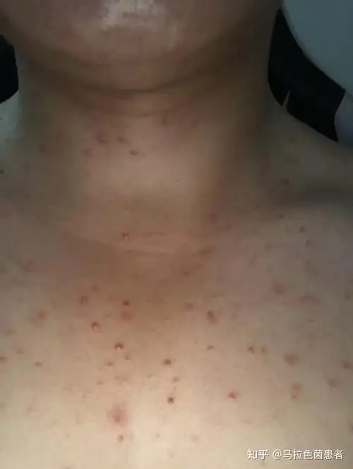 大家帮我看一下我这是毛囊炎吗,胸口反反复复一年了一直这样? - 知乎