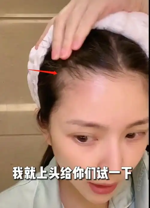 杜淳老婆自曝怀孕产女后脱发严重,发缝变宽发际线后移,出门要靠粉遮挡