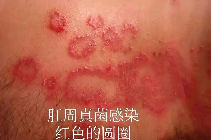 疫情下,肛门瘙痒症如何在家处理_瘙痒症_相关疾病_日常注意事项 - 好