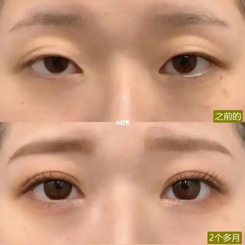 之前眼睛有点提肌无力,没有精神,宋主任说直接ga双眼皮就可以.