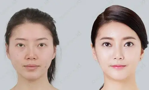 韩国整形医院脂肪填充前后对比照片