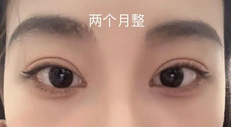 埋线双眼皮