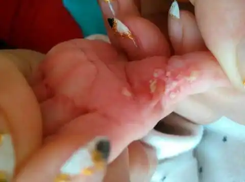 小孩才十七天,指缝上有白泡,里面液体有点黄白色