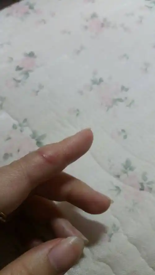 年前几天水果刀不小心割到手了 略深 现在变成这样