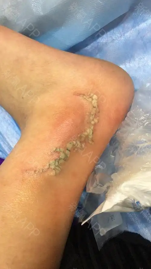 【术后0天】今天直播我的祛纹身,敷了麻药差不多半个_圈子-新氧美容