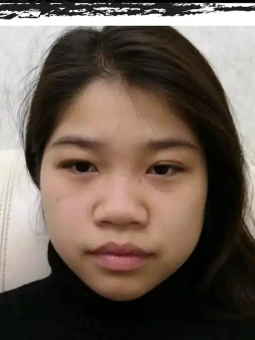 如图2,我鼻子的主要问题是鼻翼比较肥厚,山根不够高,鼻头比较大,照