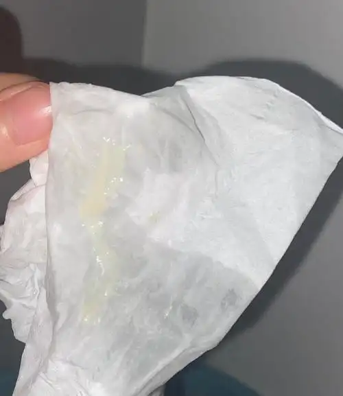 细菌性阴道炎以及外阴红肿有白带图慎入