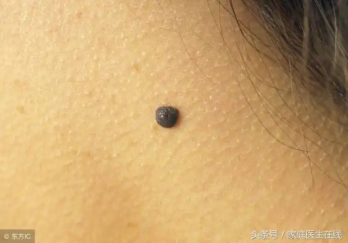 黑痣怎么去除脸上长痣怎么去掉