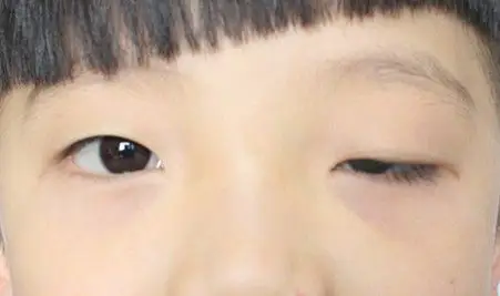 上睑下垂专家科普视频6儿童上睑下垂手术的分类