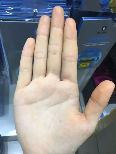 手发黄怎么回事?别人都说我的手怎么这么黄么,求帮助