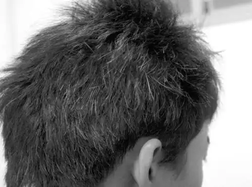 2. 后脑勺白发:肾脏