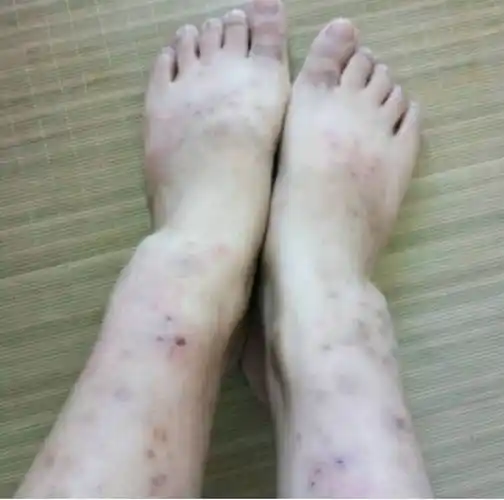 湿疹一般多久能好(热毒湿疹要多久才会好)_句子贝贝