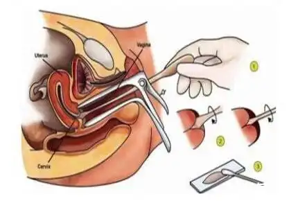 67宫颈癌早期症状及自检筛查方法宫颈癌能治好吗