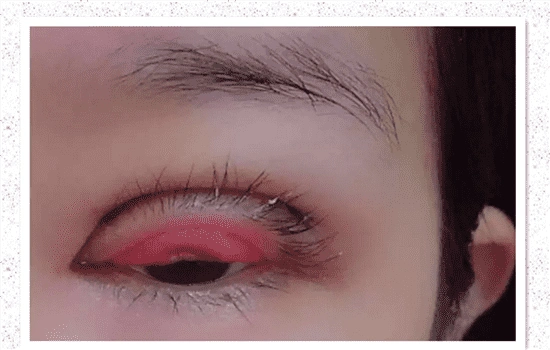 眼睑下垂手术失败图片第三张不是真的吧