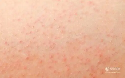 01毛囊炎多见于成年人,自觉瘙痒或有轻度疼痛,一般没有全身症状.