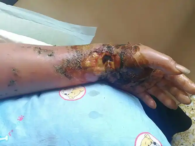 五步蛇咬伤合并溃疡感染,周围明显肿胀.