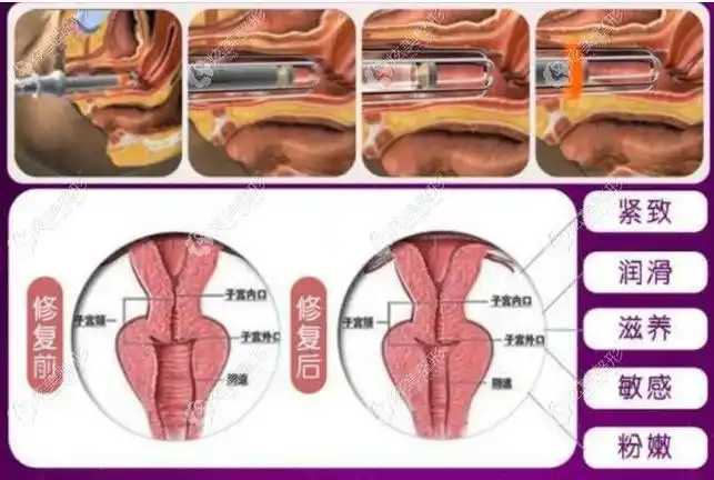fotona私密激光紧缩阴道原理