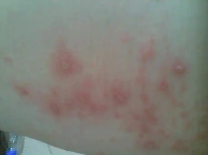 大腿内侧长红痘带脓怎么回事?而且会扩散,是什么皮肤病?要怎么医治?