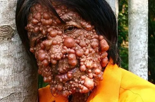 【讨论】男子浑身肿瘤疯长向世界求医