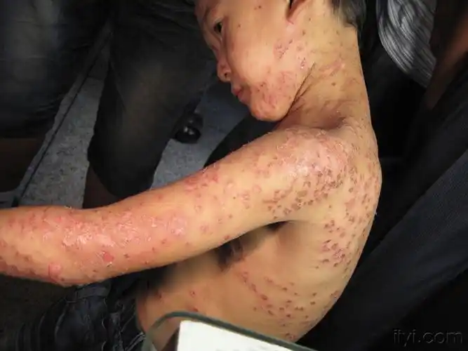 这小孩全身的皮损还只有一周多 - 皮肤及性传播疾病讨论版 - 爱爱医