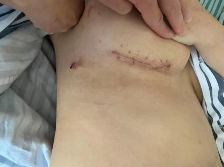 检查后,董爱强团队为她进行了胸腔镜辅助下二尖瓣成形术,手术顺利完成