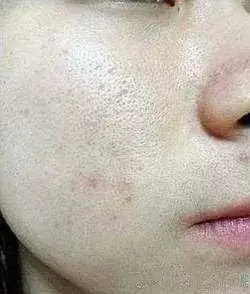 毛孔粗大之后真的不可逆收缩毛孔实用操作