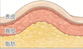 人体有两种脂肪,一种是皮下脂肪,比如抓起皮肤后那一叠叠的肉,拜拜肉