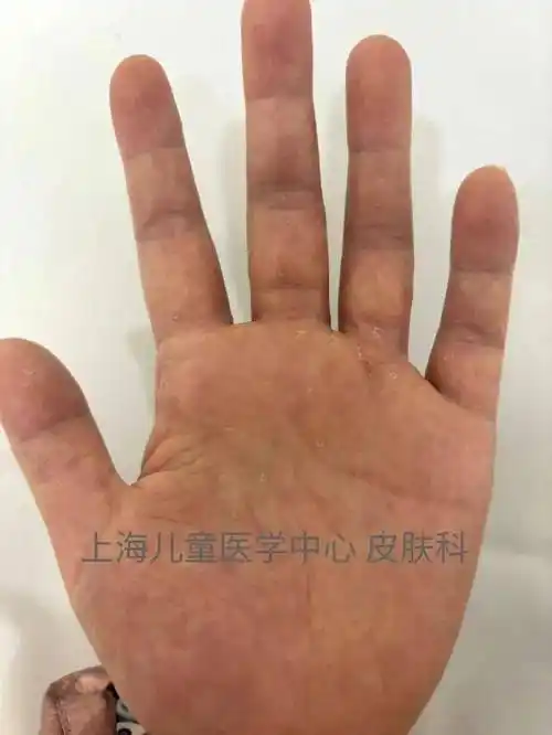 手部_孩子_皮肤