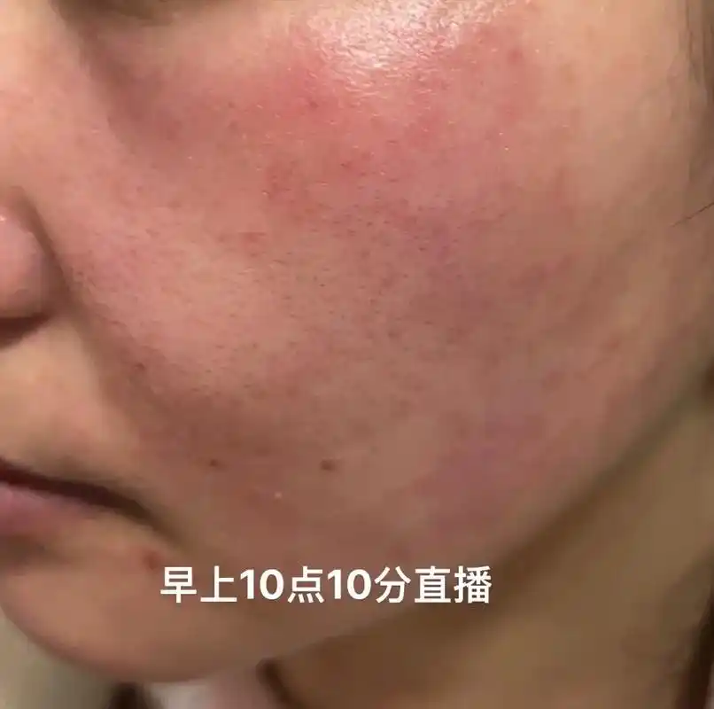 激素脸 #敏感肌 #问题性皮肤管理 #玫瑰痤疮 #红血丝  - 抖音