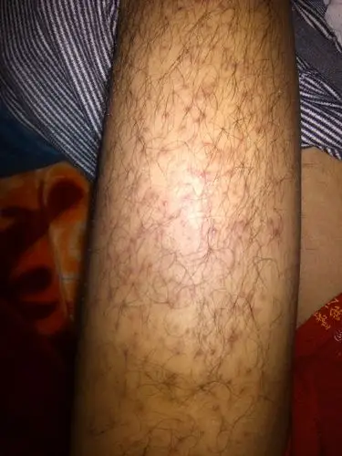 大腿上的红斑点,还有的都有长脓了!跪求这是什么状况啊,好担心啊!如图