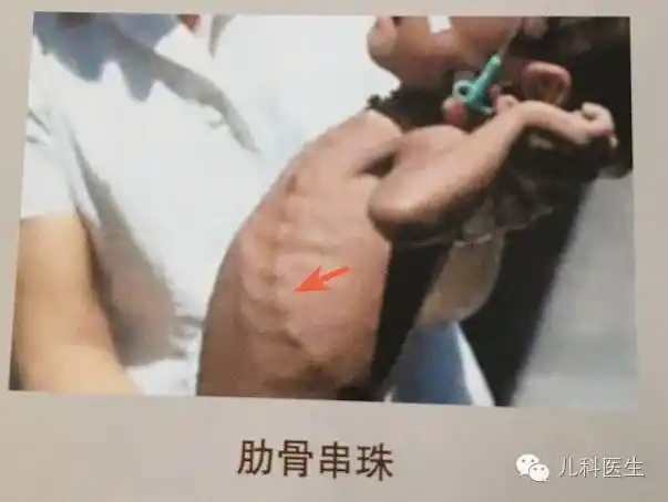 佝偻病的体征与维生素d