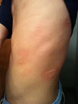 会诱发免疫系统反应,典型表现是皮肤上长类似下面这种荨麻疹,红疹子