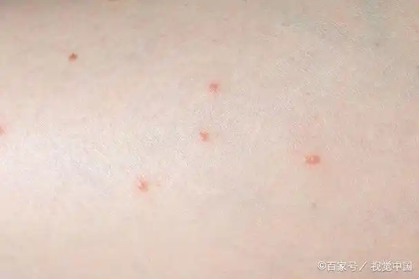 艾滋病的皮肤症状是什么?5种异常警示信号,多加留意!