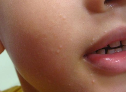 儿童软疣图片 (20)_有来医生